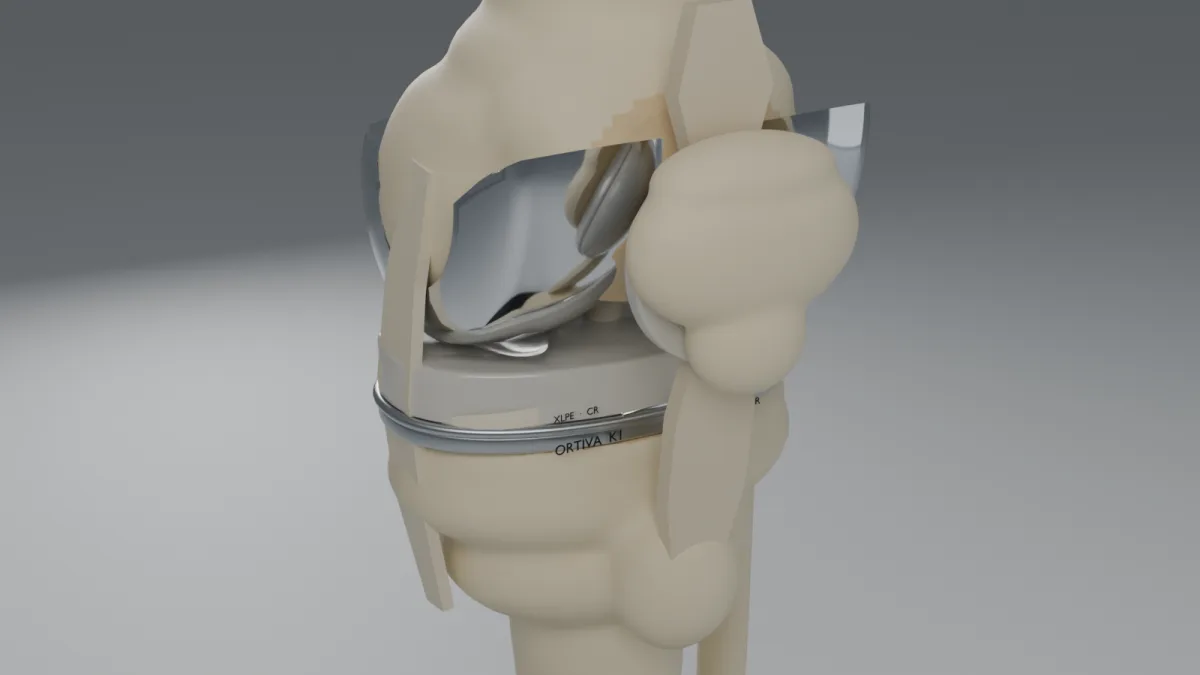 Knieendoprothese im Gelenk — Femurkomponente, Inlay und Tibiaplateau in 3D
